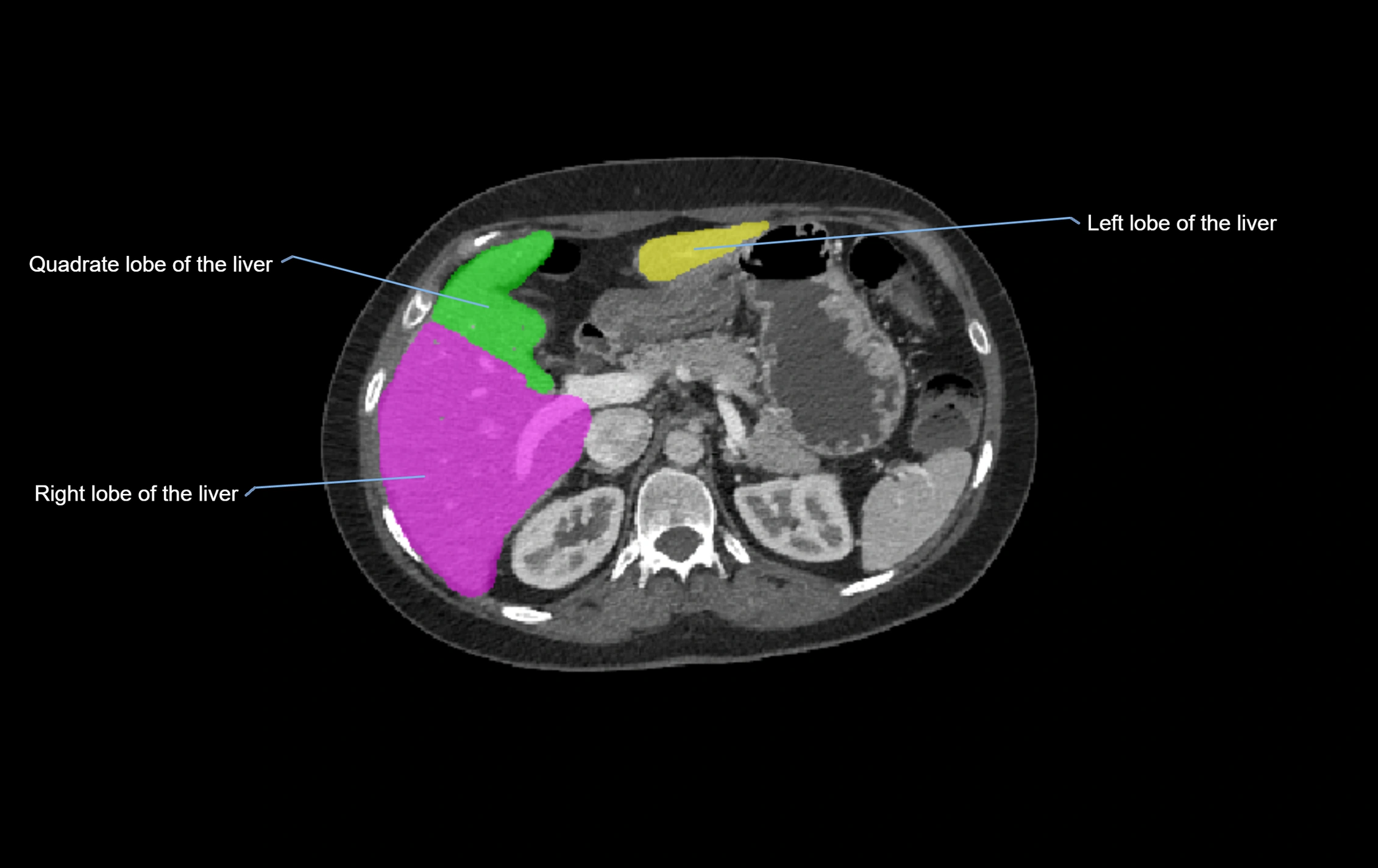 CT lliver lobes axial cross sectional anatomy labelled image -00042.webp